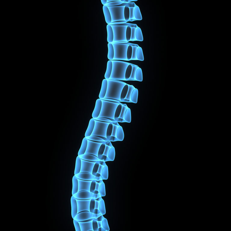 Clearwater Accidents Causing Spinal Cord Injuries DLG