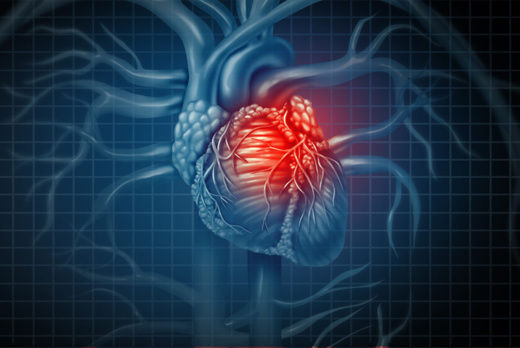 Medical Malpractice And Failure To Diagnose Cardiac Conditions