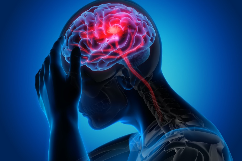 Clearwater Brain Injury Lawyer | Brain Injury Attorneys Clearwater FL