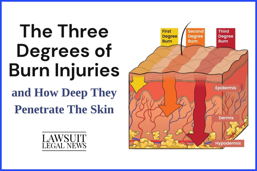 Diagram of how deep the damage goes for first second and third-degree burns